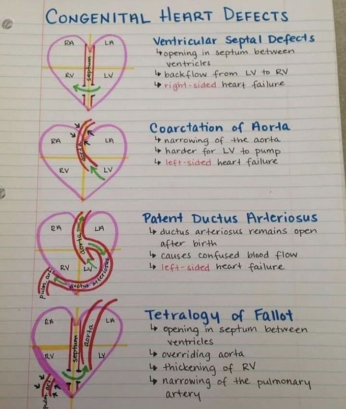 Congenital heart defects