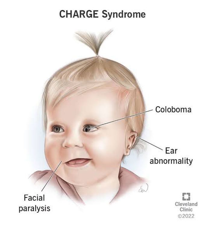 Charge Syndrome - MEDizzy