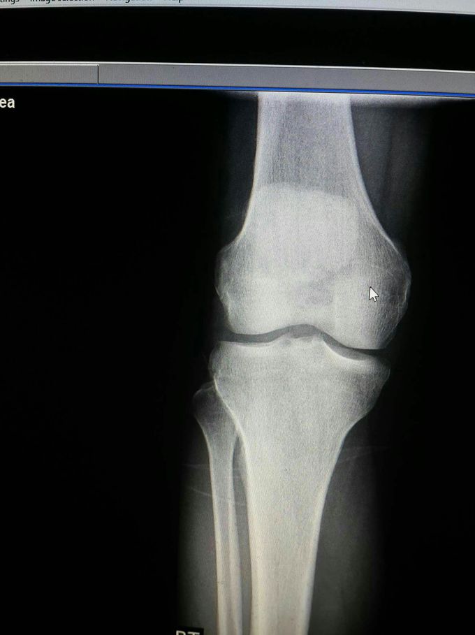 Knee joint