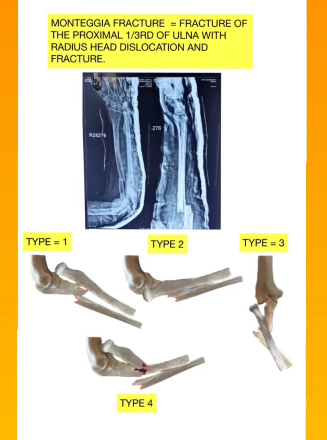 Monteggia Fracture - MEDizzy