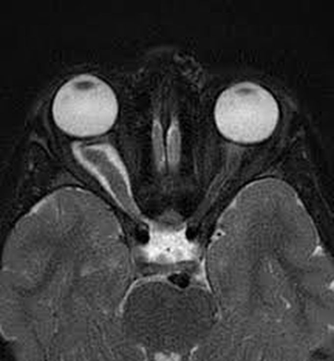 Optic nerve glioma