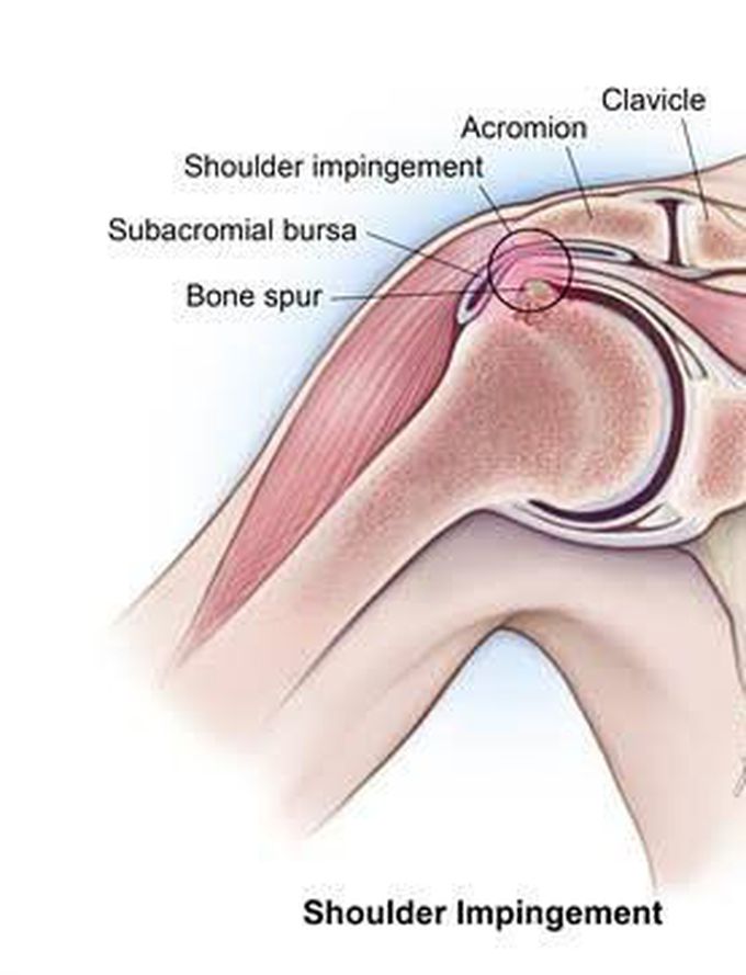 Shoulder Impingement syndrome