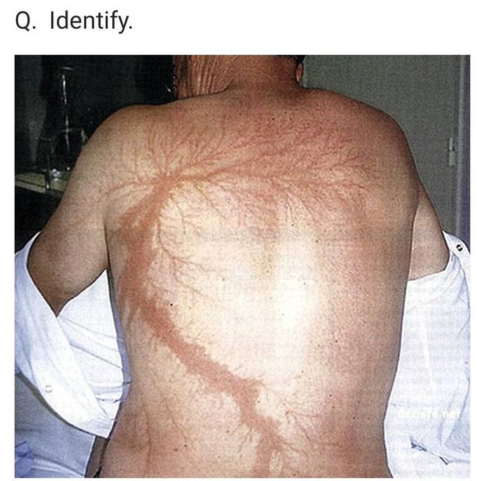 Can u identify the lesion