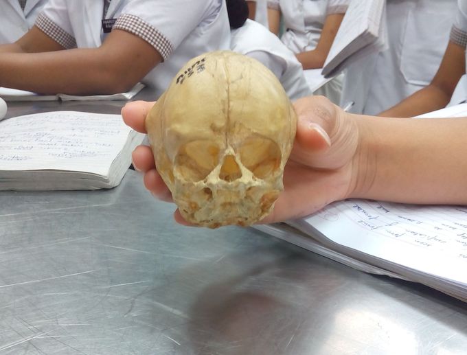 Describe this fetal skull in one word...😁
