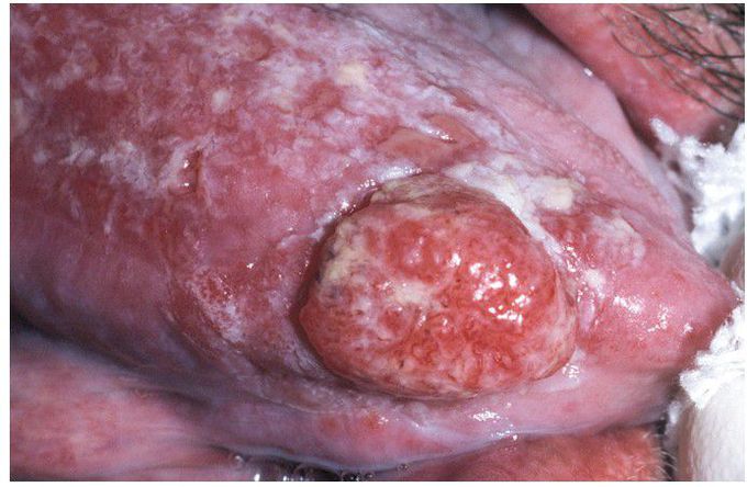 Squamous Cell Carcinoma Arising in GraftVersus-Host Disease