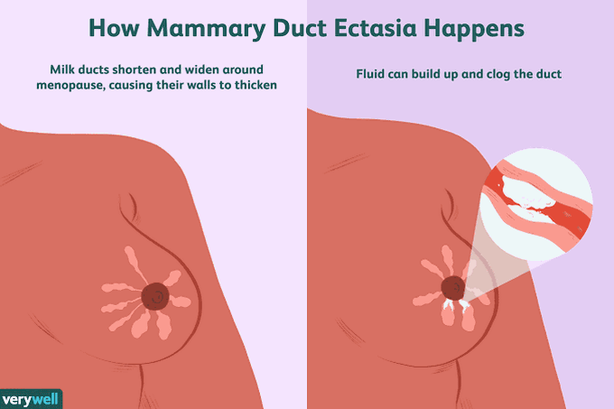 Symptoms of duct ectasia