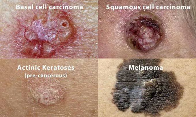 Common types of skin cancer