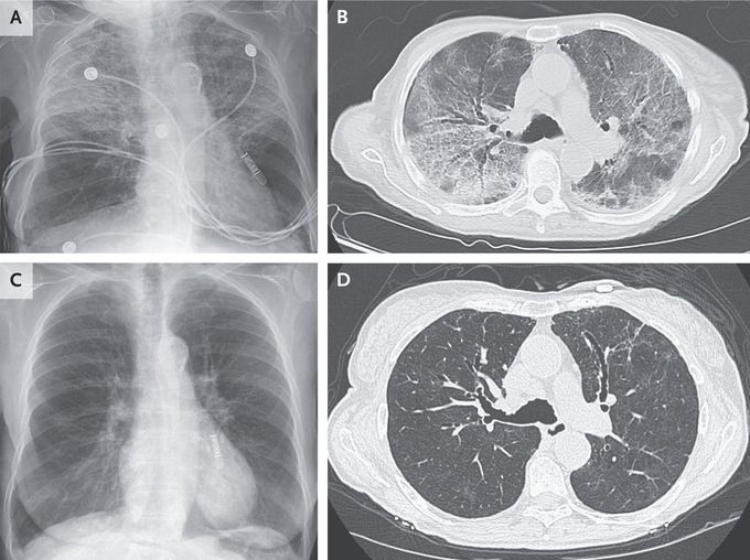 Chronic Nitrofurantoin-Induced Lung Injury