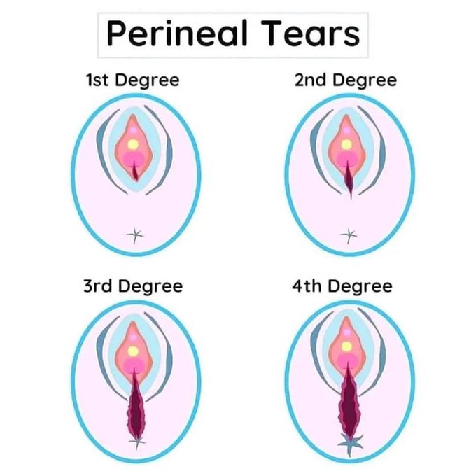 Perineal tears