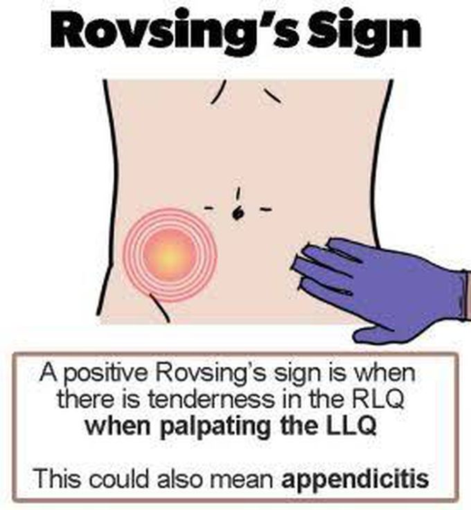 Rovsing's Sign