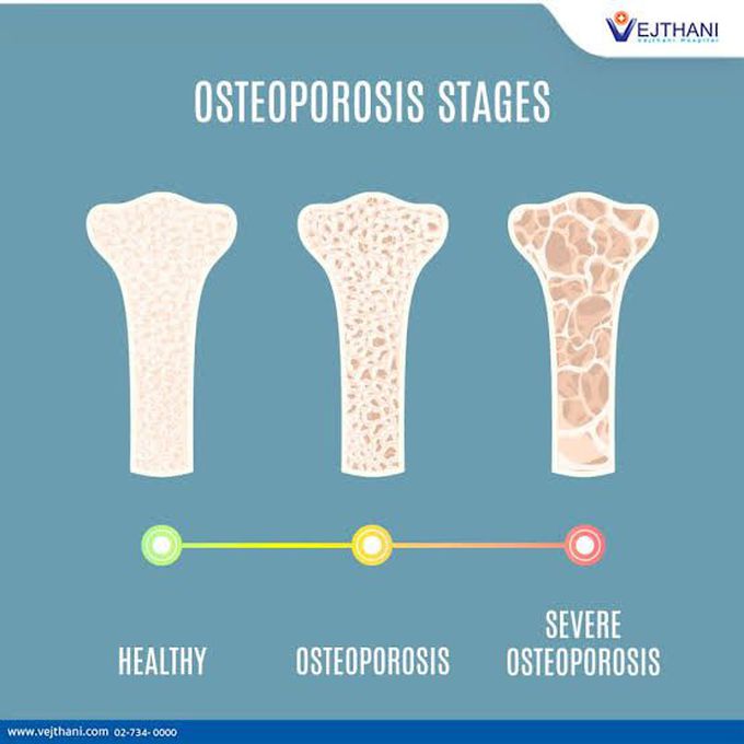 Symptoms of osteoporosis