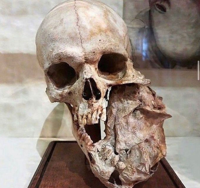 The Skull with a Tumor