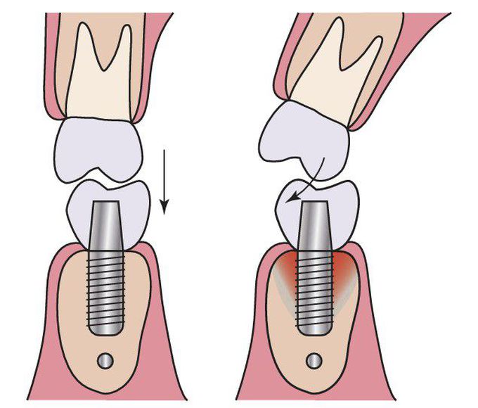 Biomechanics in implants