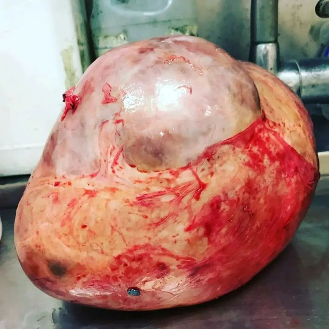 Ovarian Cyst of 4330g!