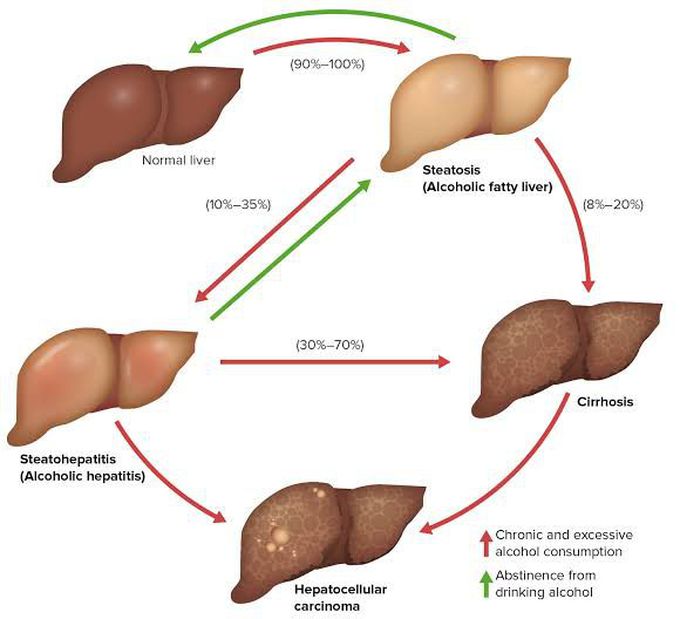 alcoholic-liver-disease-medizzy