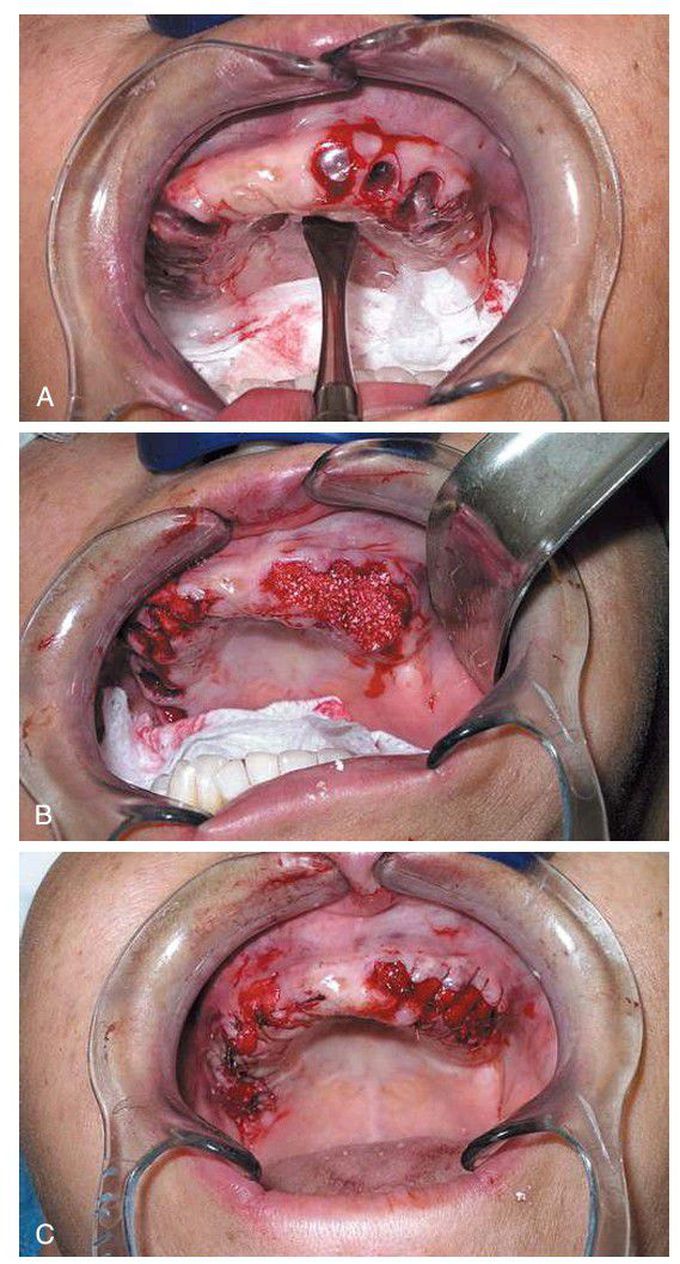 Alveolar ridge preservation