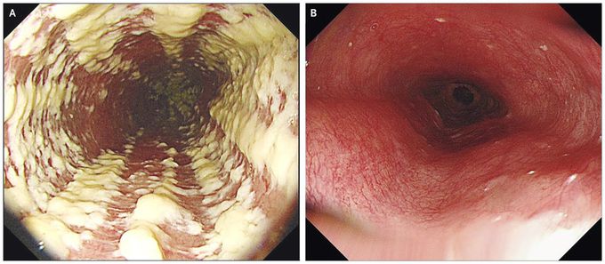 Candida Esophagitis