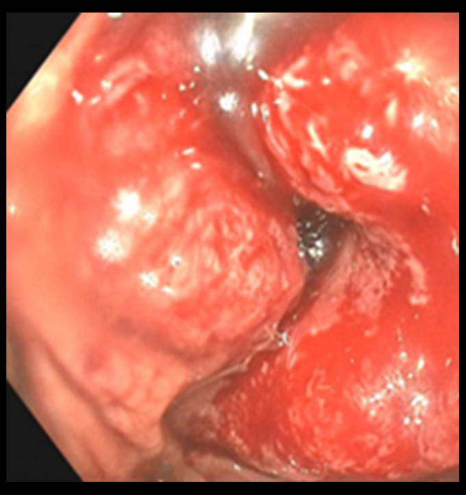 Case of colorectal cancer in a 32-year-old in the third trimester of pregnancy