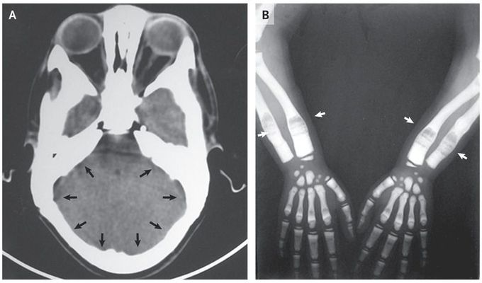 Osteopetrosis