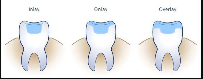 Inlay, Onlay and Overlay