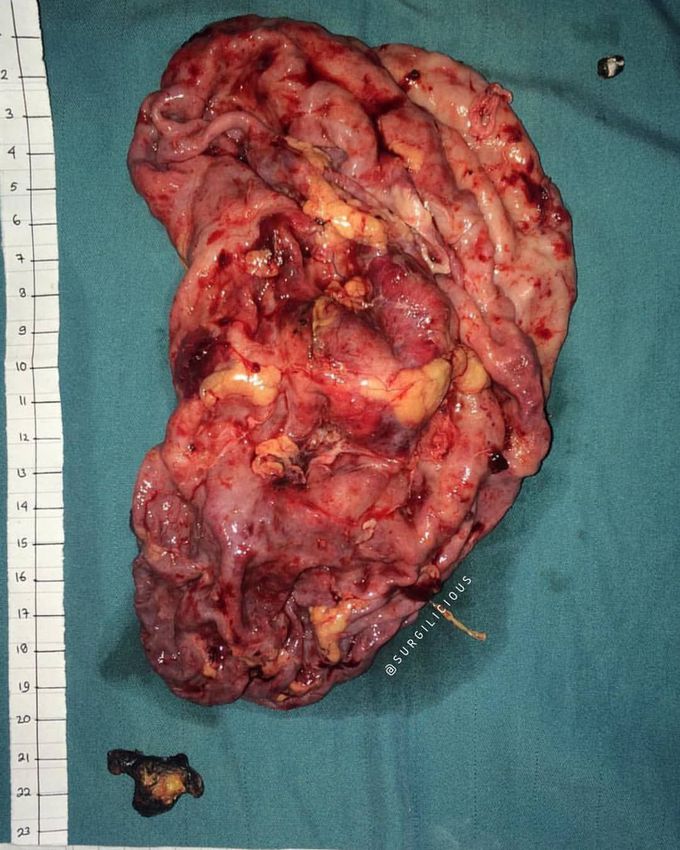 Hydronephrosis and its kidney stone