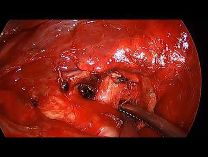 Uniportal VATS Left Posterobasal Anatomical Segmentectomy (S9+10)