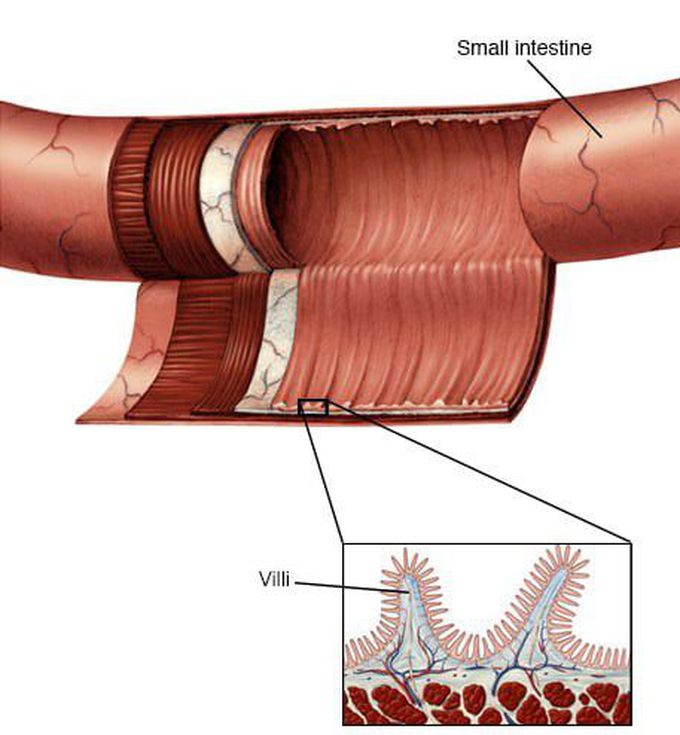 Whipple's disease