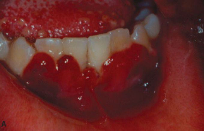 Primary HSV Infection