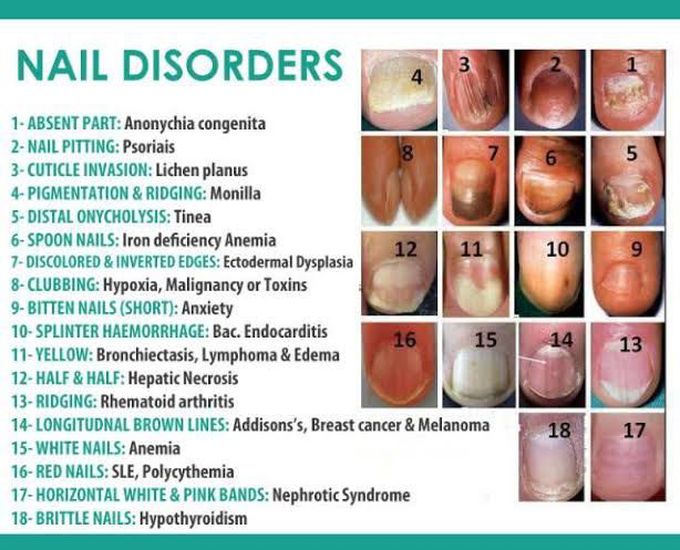 Nail disorders