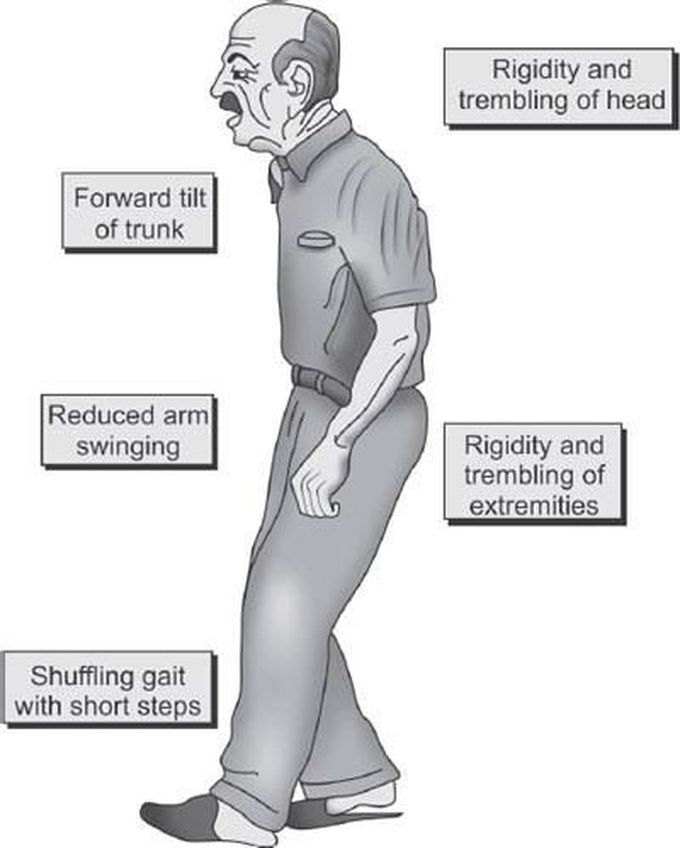 Frontal magnetic Gait