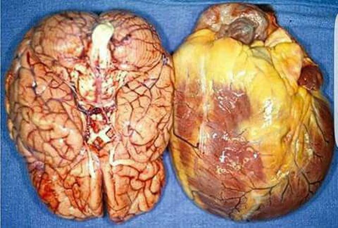 When your Heart and brain are the same size?