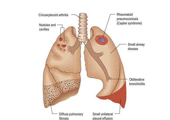 Rheumatoid disease