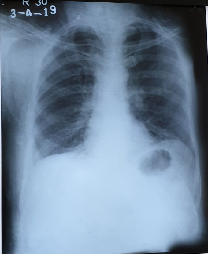 What's your diagnose ?