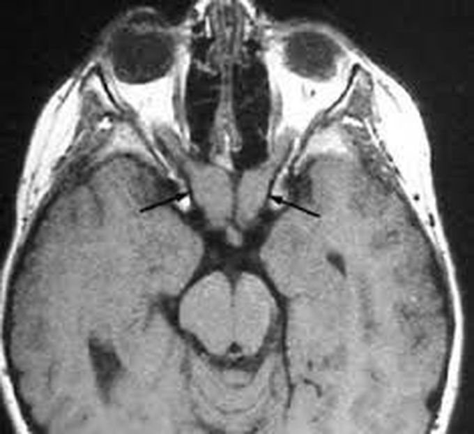 Treatment of optic nerve glioma