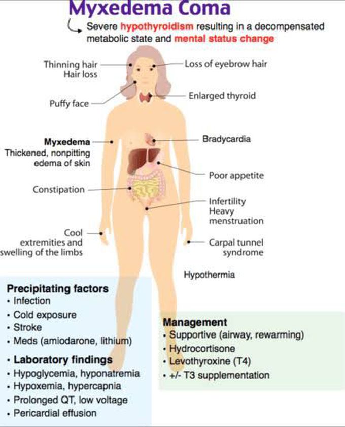 Myxedema Coma