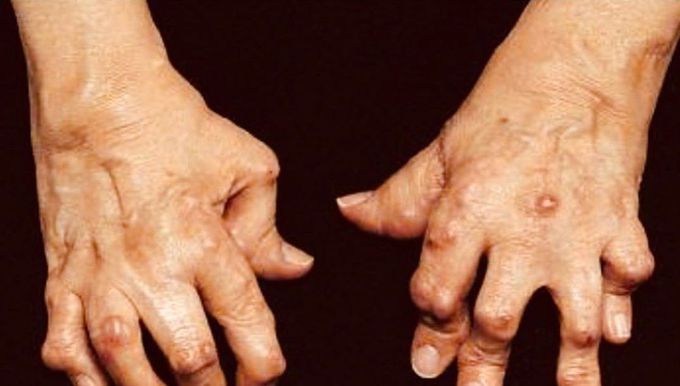 Boutonniere deformity