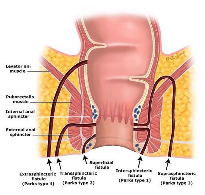 Types of Anal Fistula