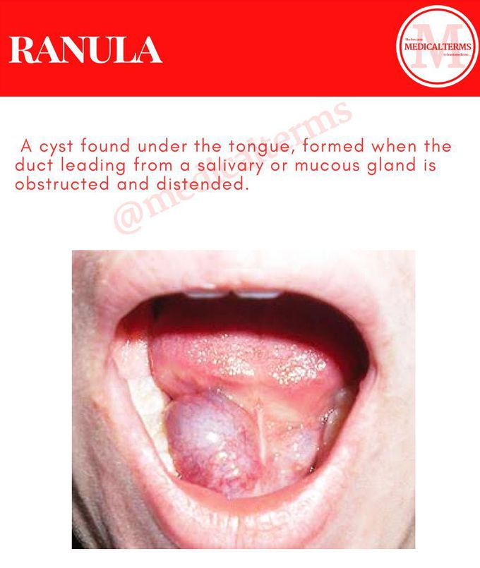 Ranula