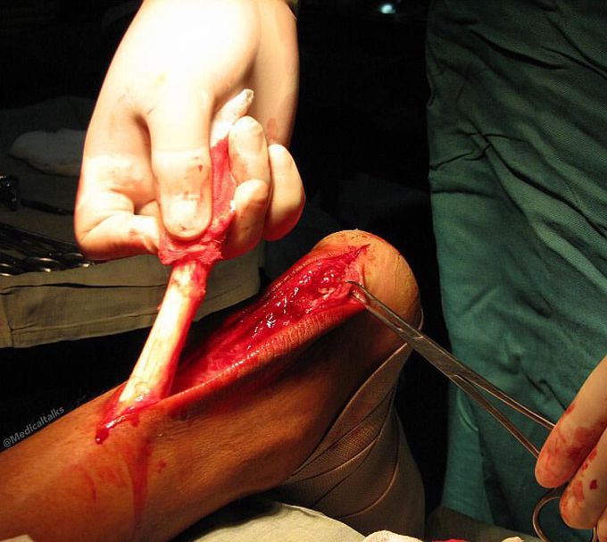 Surgical reconstruction of the Achilles' tendon