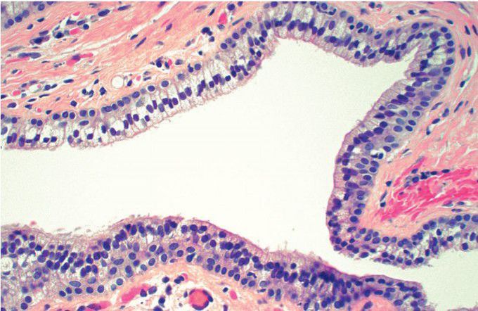 Nasolabial cyst