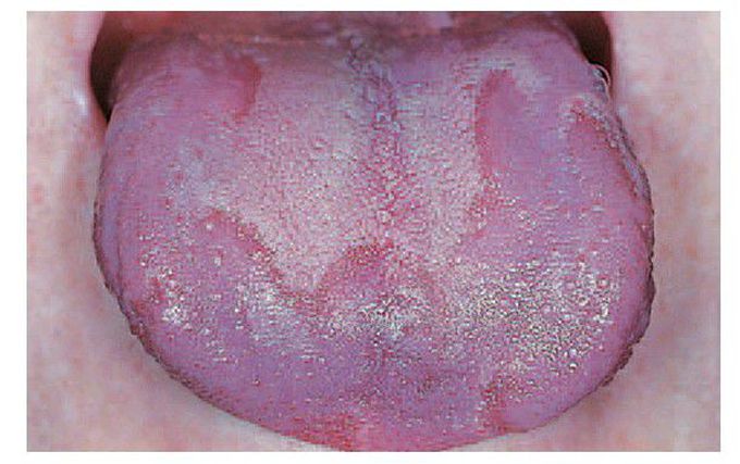 Erythma migrans
