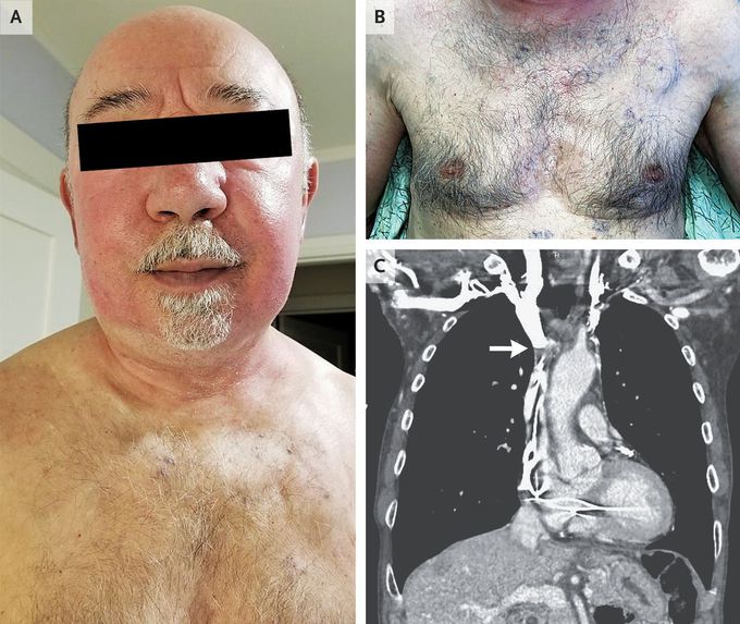 Pacemaker-Associated Superior Vena Cava Syndrome