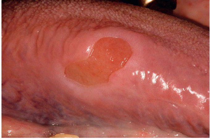 Chemotherapy-related Ulceration.