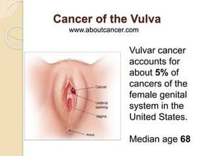 Treatment of vulvul cancer