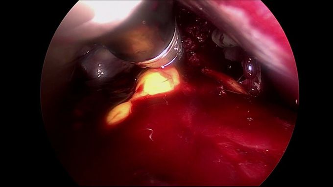 Lap splenectomy in a trauma patient needing prolonged urgent orthopaedic surgery in prone position
