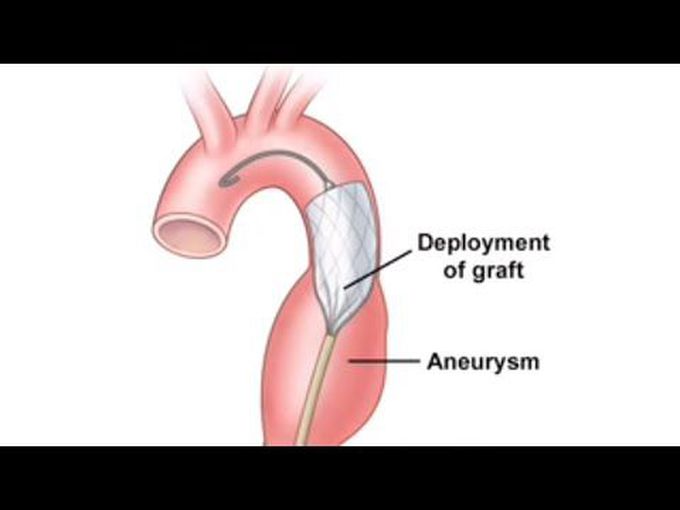Thoracic Aortic Aneurysms-
Treatment options