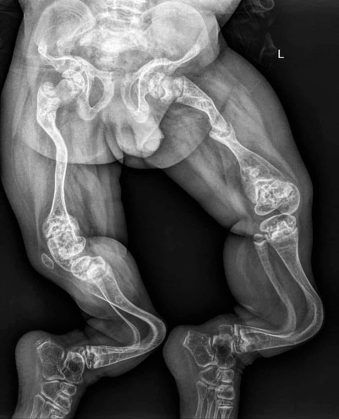 Osteogenesis