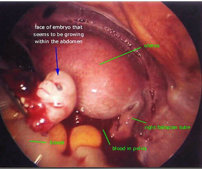 Abdominal pregnancy !!!