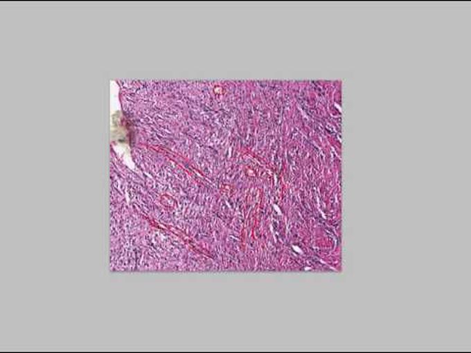 Histology of Granulation Tissue