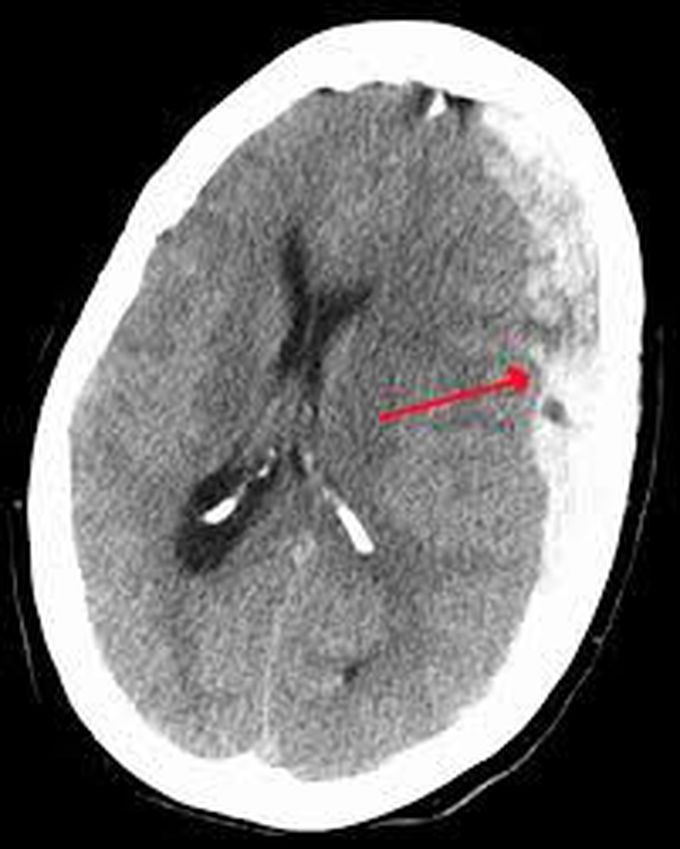 Subdural hematoma